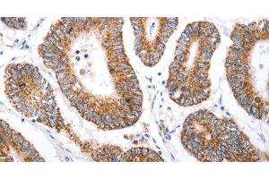 Immunohistochemistry of paraffin-embedded Human colon cancer tissue using HCRTR1 Polyclonal Antibody at dilution 1:70 (HCRTR1 antibody)
