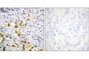 Immunohistochemistry analysis of paraffin-embedded human lung carcinoma tissue, using IGF2R (Ab-2484) Antibody. (IGF2R antibody  (AA 2441-2490))