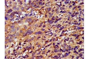 IHC image of ABIN7159577 diluted at 1:400 and staining in paraffin-embedded human ovarian cancer performed on a Leica BondTM system. (METAP1 antibody  (AA 54-125))