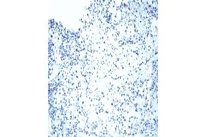 VHL Immunohistochemical staining on human renal cell carcinoma. (VHL antibody  (AA 1-213))