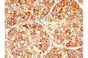 Immunohistochemistry of paraffin-embedded human liver cancer using ABIN7150701 at dilution of 1:100 (MEK2 antibody  (AA 264-400))