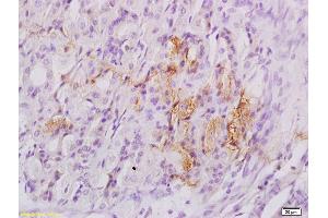Formalin-fixed and paraffin embedded human breast carcinoma labeled with Anti-phospho-eIF4EBP1(Thr37/46) Polyclonal Antibody, Unconjugated (ABIN682978) followed by conjugation to the secondary antibody and DAB staining