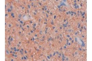 DAB staining on IHC-P; Samples: Human Glioma Tissue (Factor VII antibody  (AA 334-452))