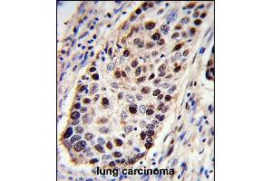 PCNA Antibody (C-term) (ABIN389344 and ABIN2839453) immunohistochemistry analysis in formalin fixed and paraffin embedded human lung carcinoma followed by peroxidase conjugation of the secondary antibody and DAB staining.