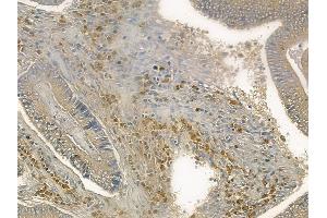 ABIN6260996 and ABIN6272569 at 1/100 staining human colon carcinoma by IHC-P. (COX7B antibody  (Internal Region))