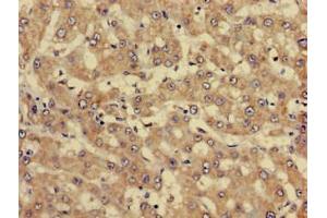 Immunohistochemistry of paraffin-embedded human liver cancer using ABIN7144337 at dilution of 1:100 (SERPINC1 antibody  (AA 37-180))