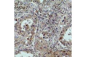 Immunohistochemical analysis of MICU1 staining in human lung cancer formalin fixed paraffin embedded tissue section. (MICU1 antibody)