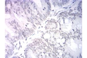 Immunohistochemical analysis of paraffin-embedded rectum cancer tissues using Neurod mouse mAb with DAB staining. (NEUROD1 antibody  (AA 26-91))