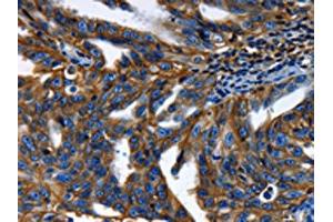 The image on the left is immunohistochemistry of paraffin-embedded Human ovarian cancer tissue using ABIN7189591(ABCC5 Antibody) at dilution 1/50, on the right is treated with synthetic peptide. (ABCC5 antibody)
