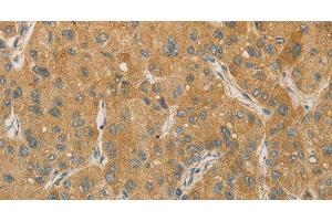 Immunohistochemistry of paraffin-embedded Human liver cancer tissue using PRPSAP1 Polyclonal Antibody at dilution 1:80 (PRPSAP1 antibody)