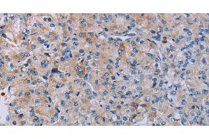 Immunohistochemistry of paraffin-embedded Human prostate cancer using P2RY2 Polyclonal Antibody at dilution of 1:40 (P2RY2 antibody)