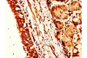 IHC image of ABIN7161457 diluted at 1:300 and staining in paraffin-embedded human lung cancer performed on a Leica BondTM system.