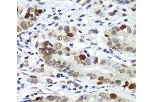 Immunohistochemistry of paraffin-embedded Human gastric cancer using DR1 Polyclonal Antibody at dilution of 1:100 (40x lens). (DR1 antibody)