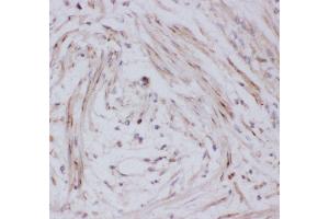 Anti-GLUT4 Picoband antibody,  IHC(P): Human Intestinal Cancer Tissue (GLUT4 antibody  (AA 333-509))