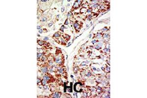 Formalin-fixed and paraffin-embedded human hepatocellular carcinoma tissue reacted with EZH1 polyclonal antibody  , which was peroxidase-conjugated to the secondary antibody, followed by DAB staining . (EZH1 antibody  (Internal Region))
