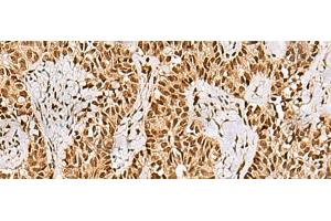 Immunohistochemistry of paraffin-embedded Human ovarian cancer tissue using PHF5A Polyclonal Antibody at dilution of 1:55(x200) (PHF5A antibody)