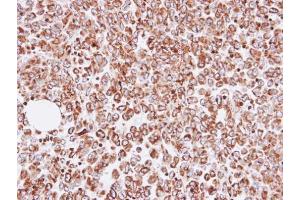 IHC-P Image Immunohistochemical analysis of paraffin-embedded human gastric cancer, using OAT, antibody at 1:100 dilution. (OAT antibody)