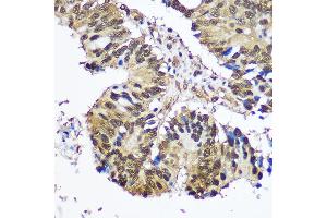 Immunohistochemistry of paraffin-embedded Human colon carcinoma using UB antibody (2359) at dilution of 1:100 (40x lens).
