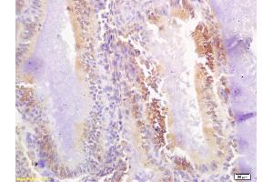 Formalin-fixed and paraffin embedded human breast carcinoma labeled with Rabbit Anti Phospho-BAP1(Ser592) Polyclonal Antibody, Unconjugated (ABIN683413) at 1:200 followed by conjugation to the secondary antibody and DAB staining (BAP1 antibody  (pSer592))