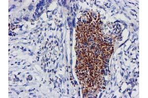 Immunohistochemical staining of paraffin-embedded Carcinoma of Human pancreas tissue using anti-EXOSC7 mouse monoclonal antibody. (EXOSC7 antibody)