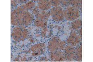 IHC-P analysis of Human Stomach Cancer Tissue, with DAB staining. (IL1A antibody  (AA 113-271))