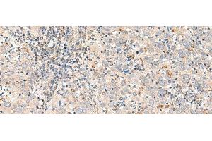 Immunohistochemistry of paraffin-embedded Human cervical cancer tissue using GALR1 Polyclonal Antibody at dilution of 1:60(x200) (Galanin Receptor 1 antibody)