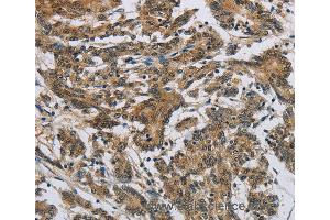 Immunohistochemistry of Human colon cancer using SYN1 Polyclonal Antibody at dilution of 1:50 (SYN1 antibody)