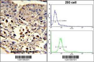 (LEFT)Formalin-fixed and paraffin-embedded human hepatocarcinoma reacted with ETHE1 Antibody (C-term), which was peroxidase-conjugated to the secondary antibody, followed by DAB staining.