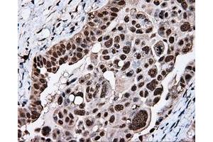 Immunohistochemical staining of paraffin-embedded Adenocarcinoma of breast tissue using anti-KIAA1609 mouse monoclonal antibody. (KIAA1609 antibody)
