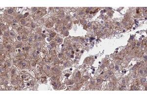 ABIN6273972 at 1/100 staining Human liver cancer tissue by IHC-P. (OR1L1 antibody)