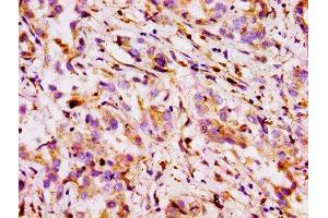 Immunohistochemistry of paraffin-embedded human liver cancer using ABIN7160310 at dilution of 1:100 (ABCB1 antibody  (AA 236-297))