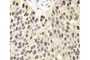 Immunohistochemistry of paraffin-embedded Human lung cancer using MCM6 Polyclonal Antibody at dilution of 1:100 (40x lens). (MCM6 antibody)