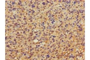 Immunohistochemistry of paraffin-embedded human glioma using ABIN7149878 at dilution of 1:100 (DKK1 antibody  (AA 33-266))