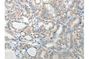 The image on the left is immunohistochemistry of paraffin-embedded Human thyroid cancer tissue using ABIN7189711(AGAP1 Antibody) at dilution 1/25, on the right is treated with synthetic peptide. (AGAP1 antibody)