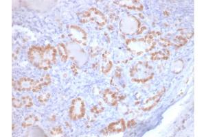 Formalin-fixed, paraffin-embedded human Lung Adenocarcinoma stained with TTF-1 Mouse Recombinant Monoclonal Antibody (rNX2. (Recombinant NKX2-1 antibody)