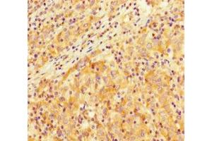 Immunohistochemistry of paraffin-embedded human lung cancer using ABIN7172403 at dilution of 1:100 (SMARCA4 antibody  (AA 808-1092))