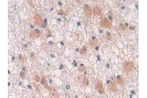 Detection of TGFb3 in Human Glioma Tissue using Polyclonal Antibody to Transforming Growth Factor Beta 3 (TGFb3) (TGFB3 antibody  (AA 24-300))