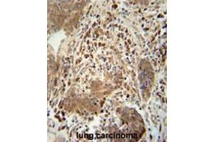 TAGAP antibody (Center) immunohistochemistry analysis in formalin fixed and paraffin embedded human lung carcinoma followed by peroxidase conjugation of the secondary antibody and DAB staining. (TAGAP antibody  (Middle Region))