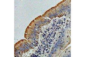 Immunohistochemical analysis of PHACS staining in human colon cancer formalin fixed paraffin embedded tissue section. (PHACS antibody)