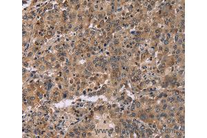 Immunohistochemistry of Human colon cancer using FAM107A Polyclonal Antibody at dilution of 1:30 (FAM107A antibody)