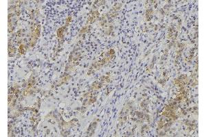ABIN6279086 at 1/100 staining Human lung cancer tissue by IHC-P.