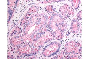 Anti-SSTR1 antibody IHC of human Prostate, Carcinoma. (SSTR1 antibody  (N-Term))