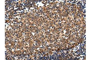 The image on the left is immunohistochemistry of paraffin-embedded Human colorectal cancer tissue using ABIN7193115(ZNF473 Antibody) at dilution 1/30, on the right is treated with synthetic peptide. (ZNF473 antibody)