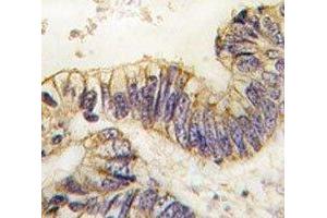 IHC analysis of FFPE human colon carcinoma tissue stained with SRC-1 antibody (NCOA1 antibody  (AA 1338-1367))