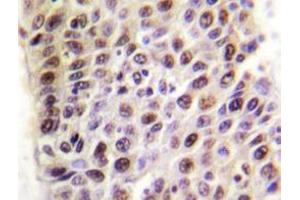 Immunohistochemistry analyzes of TIP60 antibody in paraffin-embedded human liver carcinoma tissue. (KAT5 antibody)