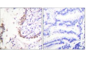 Immunohistochemical analysis of paraffin-embedded human lung carcinoma tissue, using OCT3 antibody (ABIN5976473).