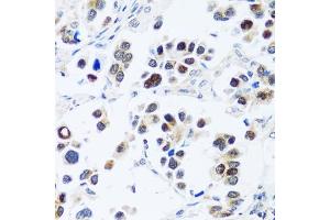 Immunohistochemistry of paraffin-embedded human lung cancer using BRIX1 antibody (ABIN7265951) at dilution of 1:100 (40x lens). (BRIX1 antibody  (AA 1-353))