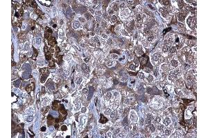 IHC-P Image MMP10 antibody detects MMP10 protein at secreted on human cervical carcinoma by immunohistochemical analysis. (MMP10 antibody)