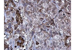 IHC-P Image MMP10 antibody detects MMP10 protein at secreted on human cervical carcinoma by immunohistochemical analysis. (MMP10 antibody)