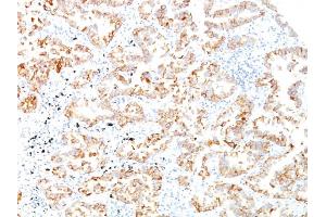 Formalin-fixed, paraffin-embedded human Lung SCC stained with Cytokeratin 7 Monoclonal Antibody (SPM270). (Cytokeratin 7 antibody)